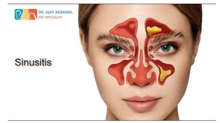 A close-up of a woman's face with a red and yellow illustration of inflamed sinuses overlaid on her nose and forehead area. Text reads "Sinusitis". The logo and name of Dr. Ajay Agrawal, ENT Specialist, are also included.