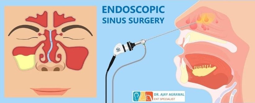 A medical illustration shows a frontal view of sinuses and a side view of an endoscope being inserted into the nasal cavity for sinus surgery. Text reads "ENDOSCOPIC SINUS SURGERY". The logo and name of Dr. Ajay Agrawal, ENT Specialist, are also included.