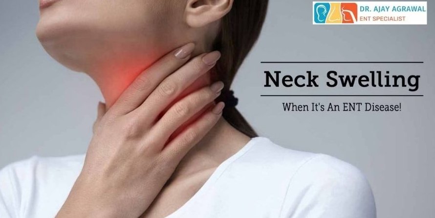 Swelling in Neck - Dr. Ajay Agrawal, Indore