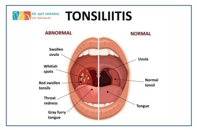 "Visual comparison of normal vs. abnormal throat anatomy showing tonsillitis symptoms by ENT specialist Dr. Ajay Agrawal."